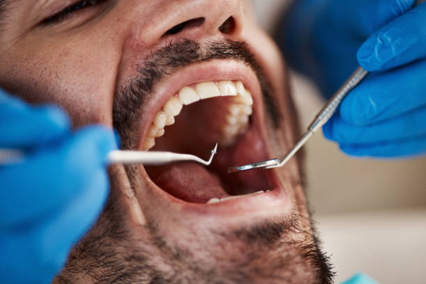 Best Emergency Dental Extractions in Ash Grove, MO