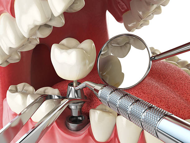 Best Emergency Dentist for Lost Fillings or Crowns in Ash Grove, MO